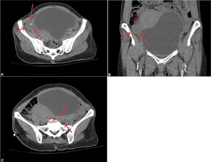 What Happens if Ovaries Are Not Visualized?